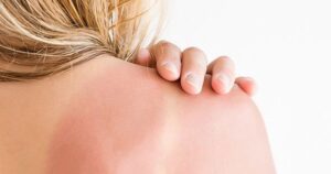 cach-lam-diu-da-khi-bi-chay